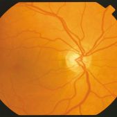 PanOptic™ Ophthalmoskop Set mit Kobalt-Filter